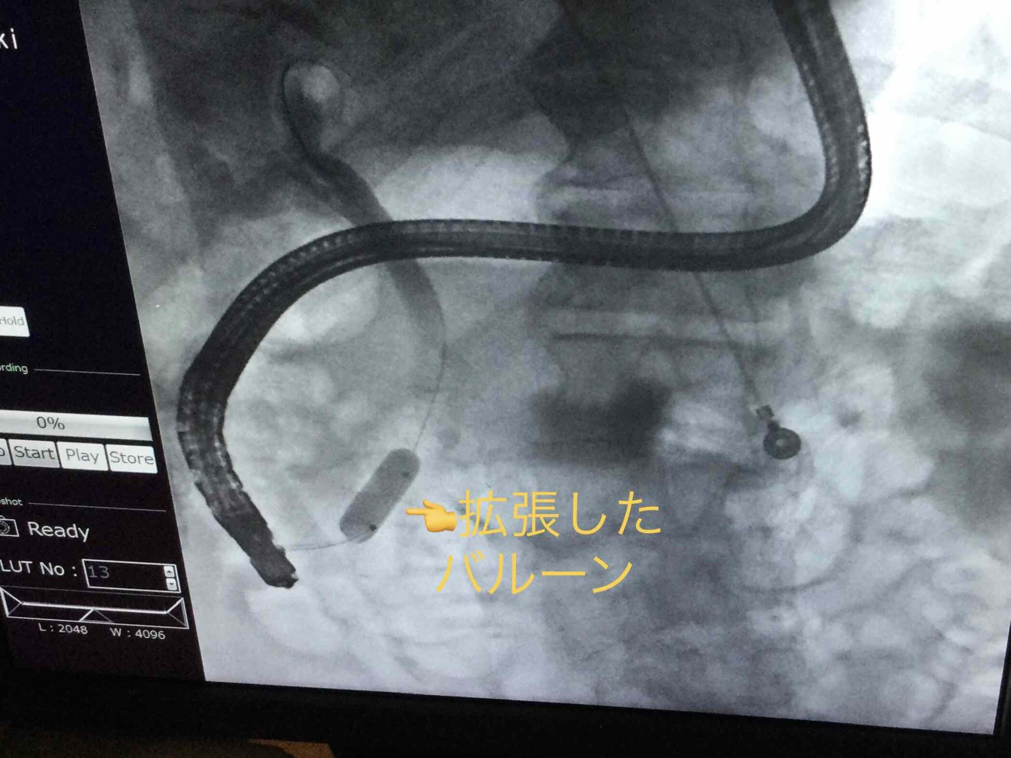 胆石のその他の治療法